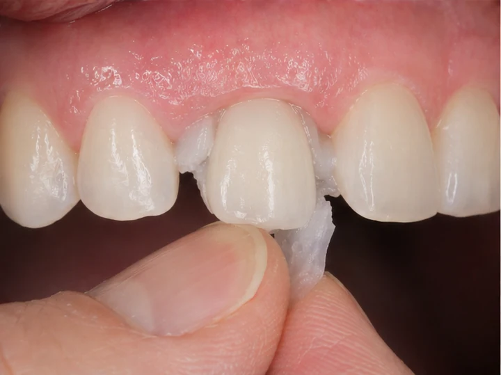 Vizuální postup vložení a dotvarování náhrady – horní přední řezák
