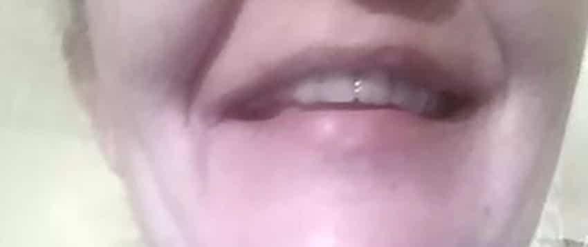 Zákaznice – přední zub doplněný Denticorem