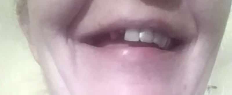 Zákaznice – zlomený přední zub, před nasazením Denticoru