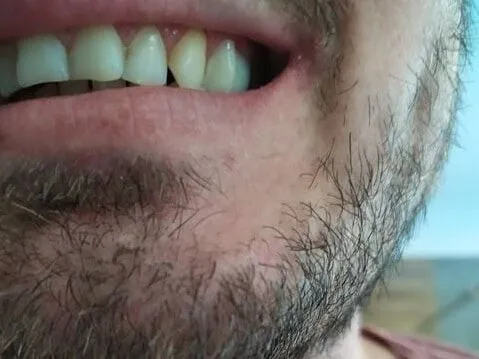 Boční zub doplněný náhradou Denticor, boční pohled