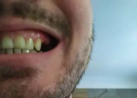 Chybějící boční zub před použitím Denticoru, boční pohled
