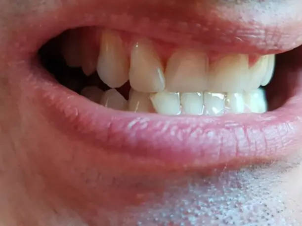 Přední zuby doplněné dočasnou náhradou Denticor