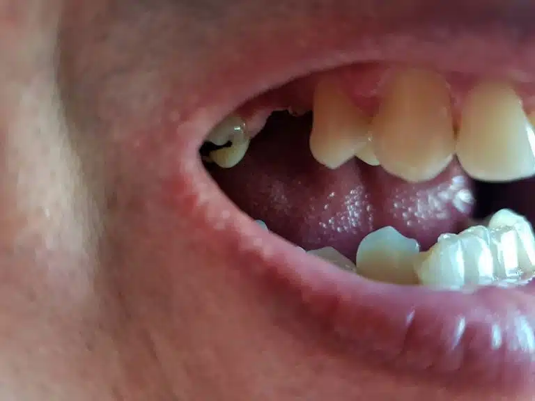 Více chybějících předních zubů před nasazením náhrady Denticor
