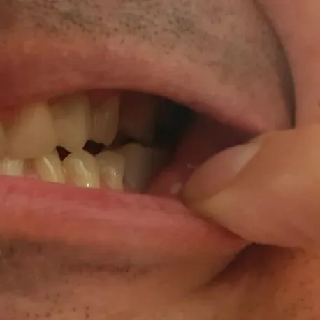 Zákazník – dolní zub doplněn Denticorem