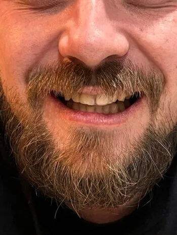 Kompletní úsměv po doplnění předního zubu náhradou Denticor