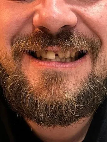 Mezera za předním zubem při úsměvu před použitím přípravku Denticor