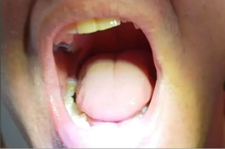 Zákaznice – boční zub doplněný Denticorem