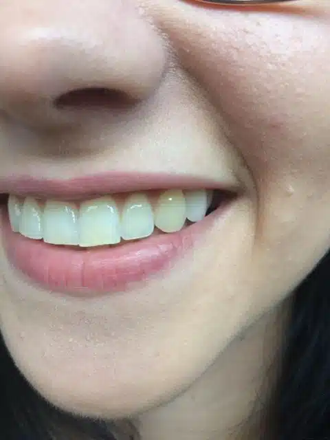 Úsměv po nasazení nového zubu na míru Denticor