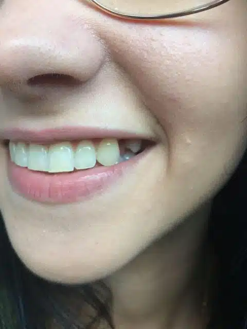 Chybějící přední zub před nasazením dočasné zubní náhrady Denticor