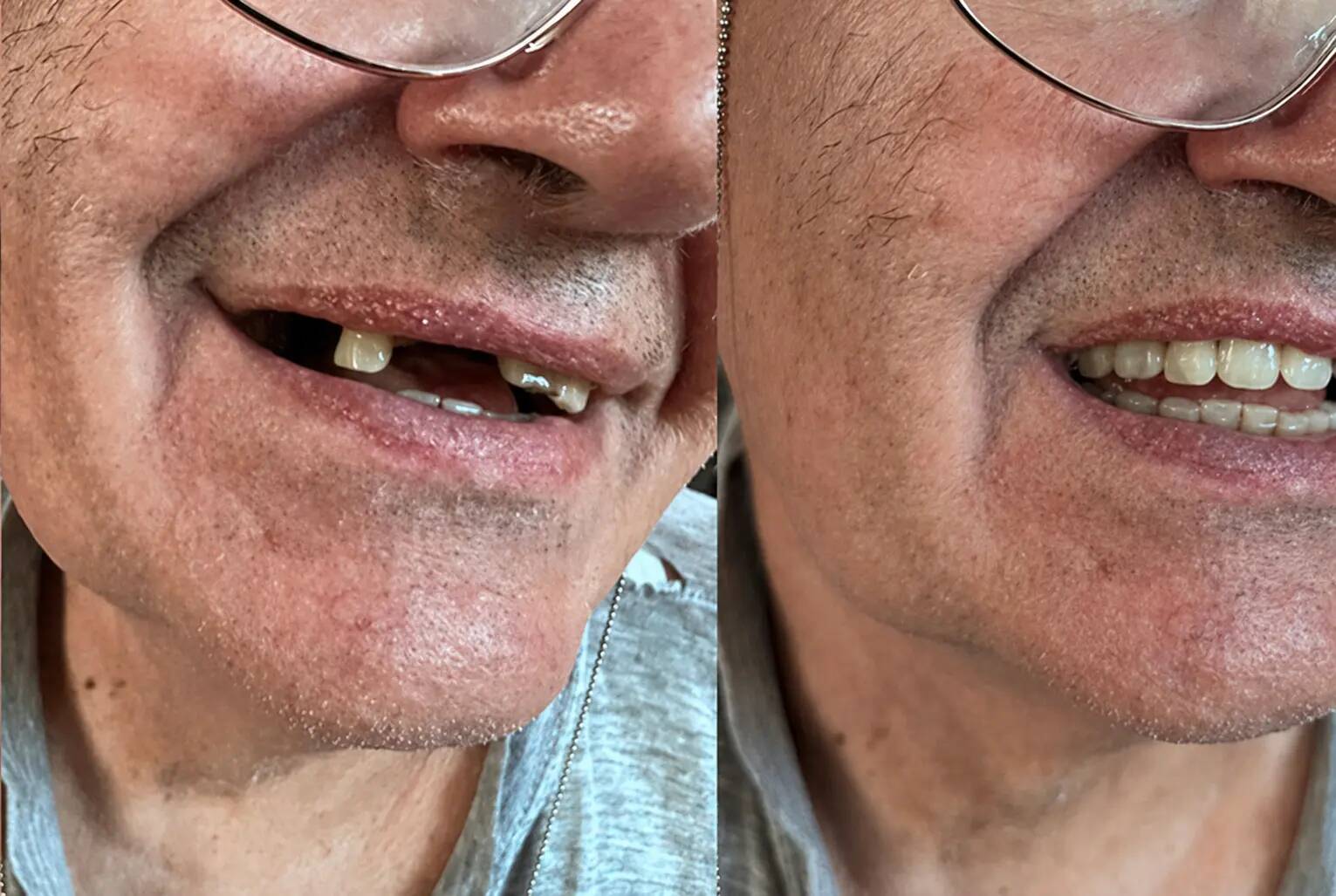 Zákazník – několik chybějících zubů před a po použití Denticoru
